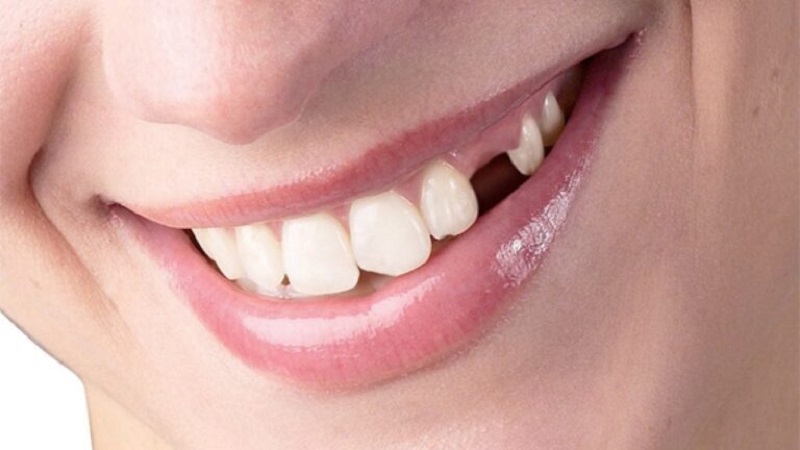 Chiêm bao thấy gãy răng ở hàm trên