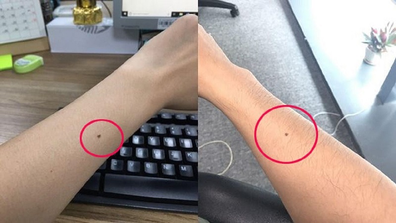 Nốt ruồi ở cổ tay có ý nghĩa gì ?