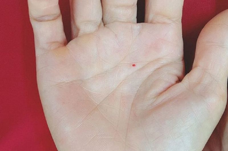 Nốt ruồi trong lòng bàn tay tốt hay xấu đối với nữ ?