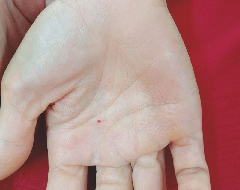 Nốt ruồi đỏ trong lòng bàn tay trái nam/nữ có ý nghĩa gì?
