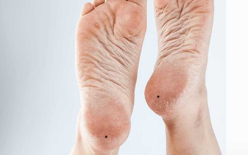 Ý nghĩa của nốt ruồi ở gót chân
